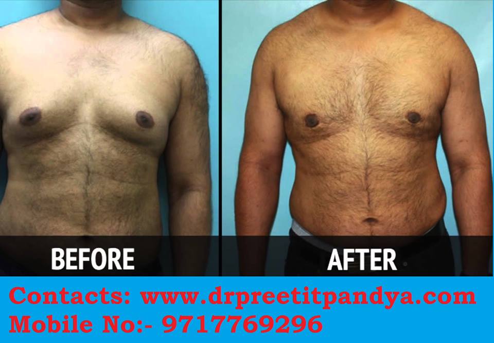 Male Breast Surgery