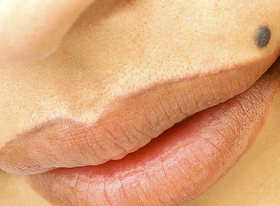 Mole Removal Treatment