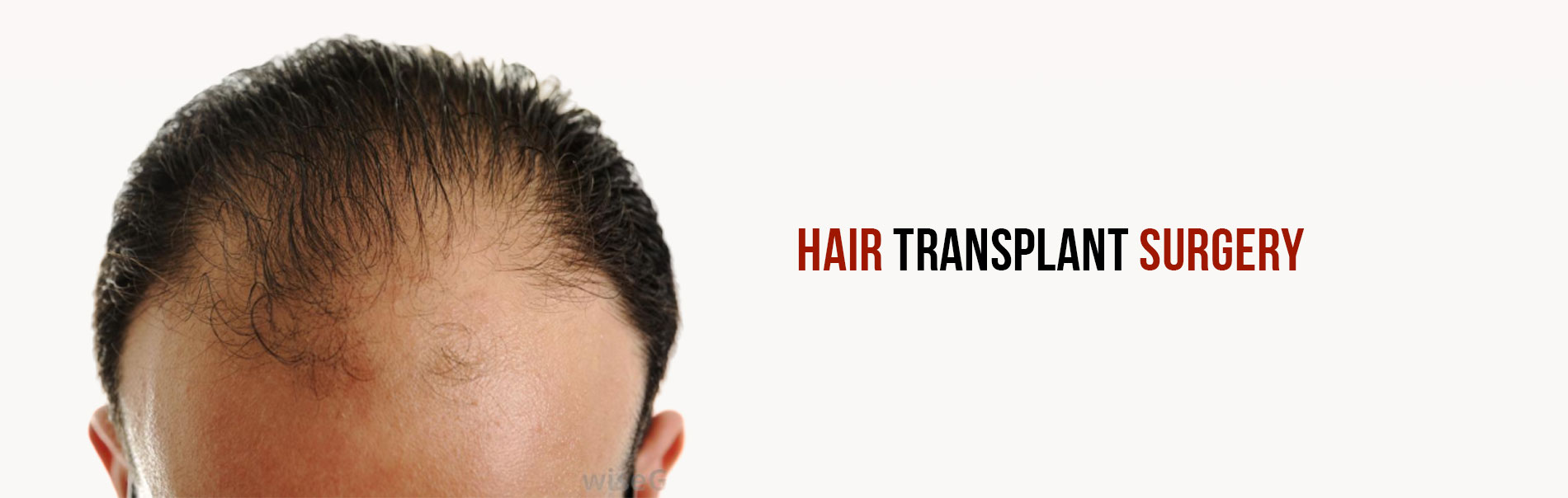 hair transplant surgery