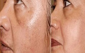 chemical peel