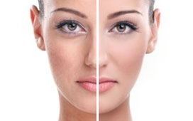 facial rejuvenation