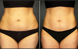 liposuction