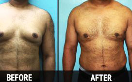 male breast reduction surgery