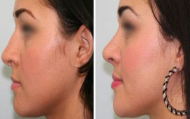 rhinoplasty surgeon