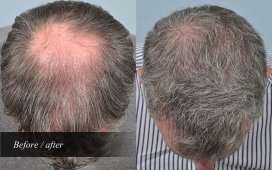 Hair Transplant Surgery