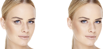 Blepharoplasty