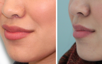 Upper Lip Shortening